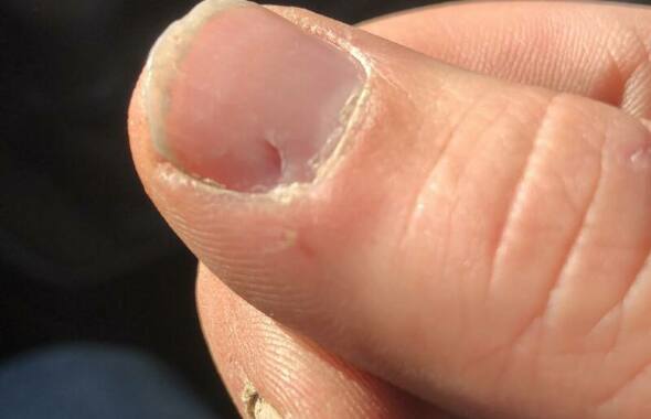 thumb