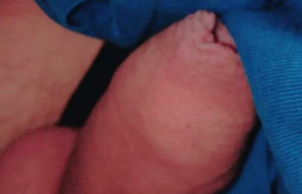 thumb