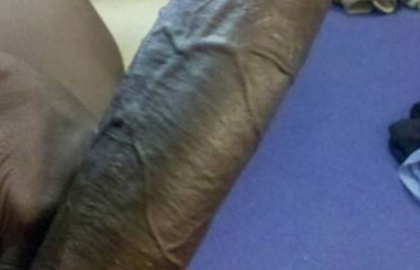 thumb