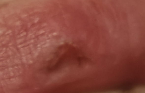 thumb