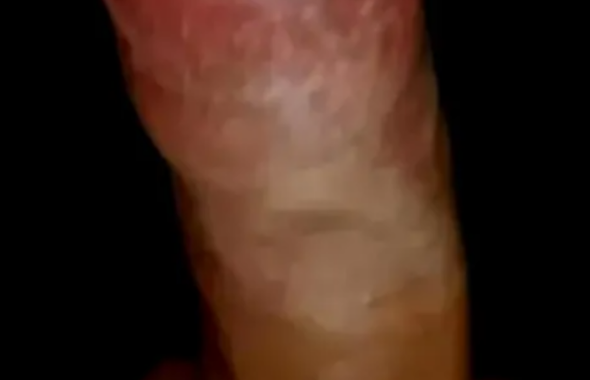 thumb